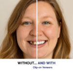 Aufsteckbare Verblendungen – Bild 3